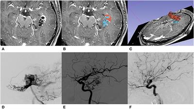 Radiosurgery-Based AVM Scale Is Proposed for Combined Embolization and Gamma Knife Surgery for Brain Arteriovenous Malformations